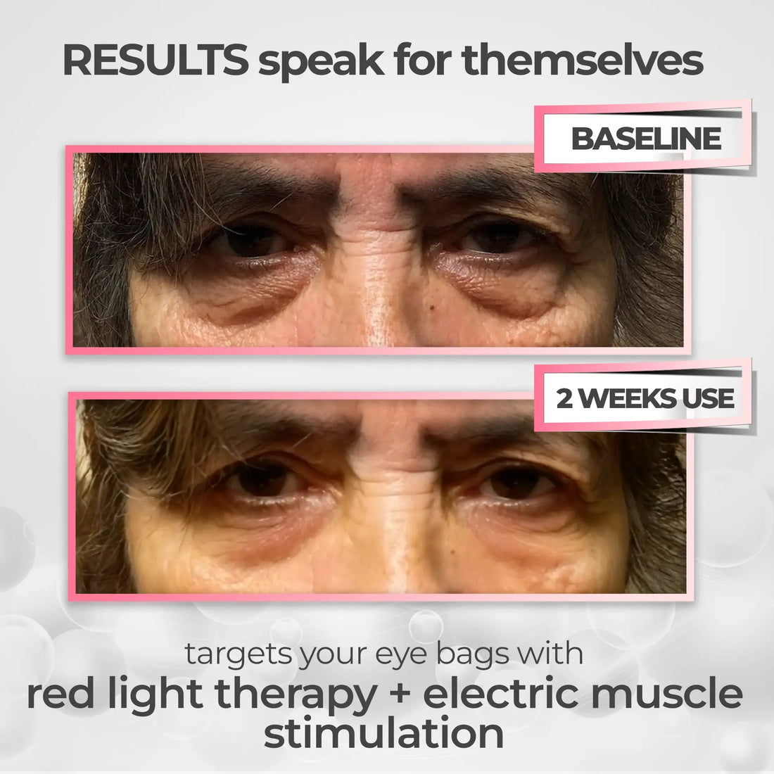 LumaEye before and after under-eye results