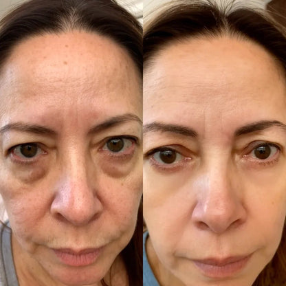 LumaEye smooths under-eye area