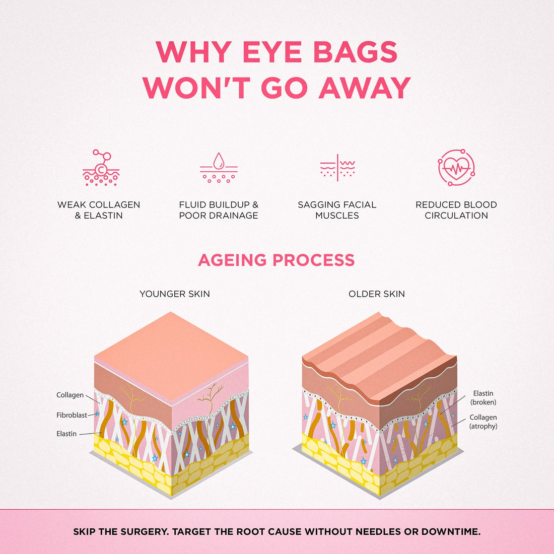 Why eye bags form