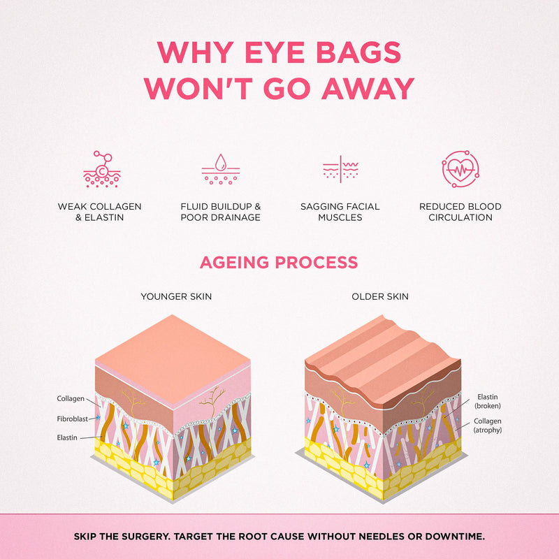 Why eye bags form