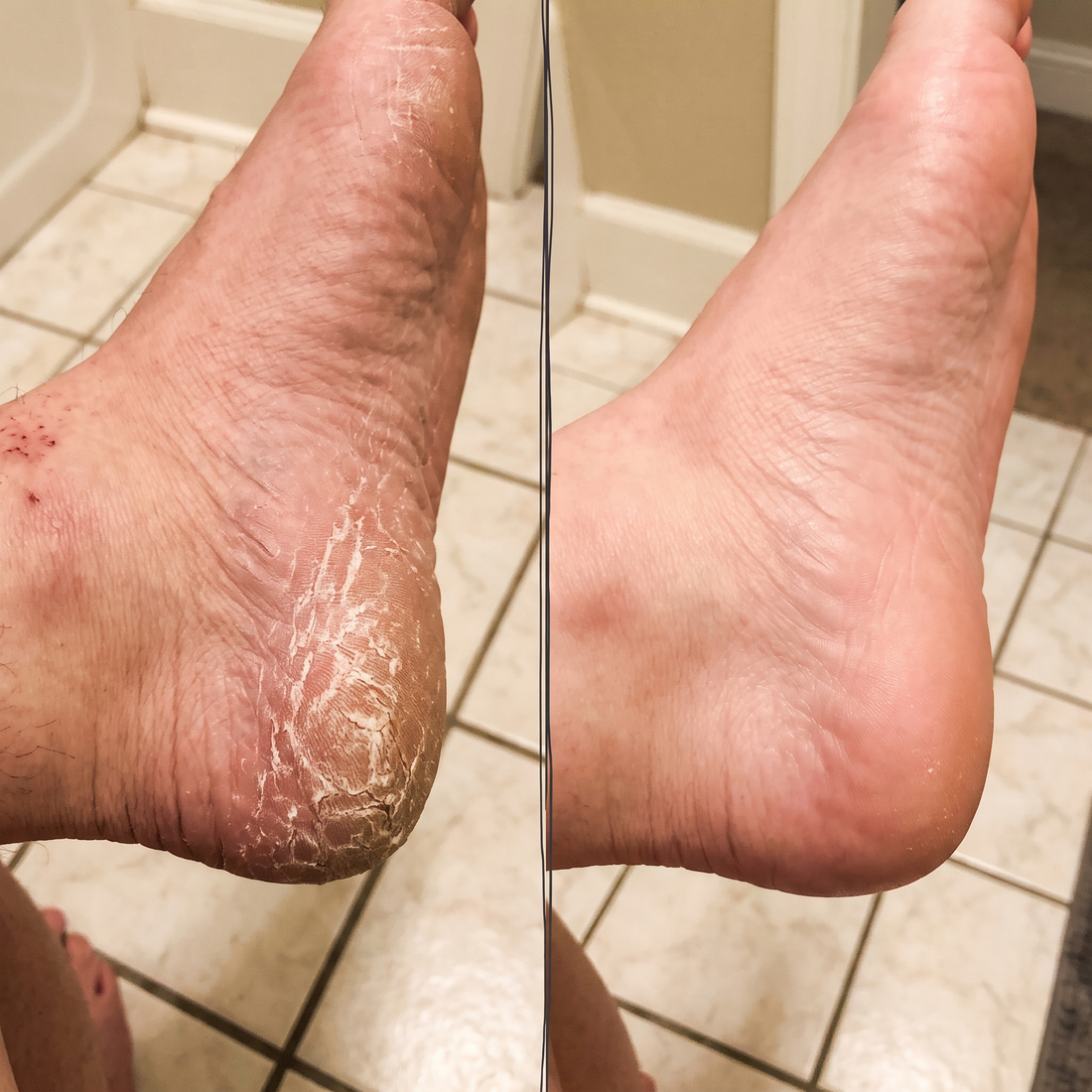 Heel before and after using the Foot Smoother Pro
