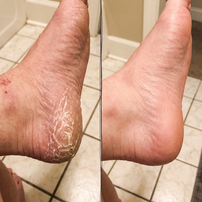 Heel before and after using the Foot Smoother Pro